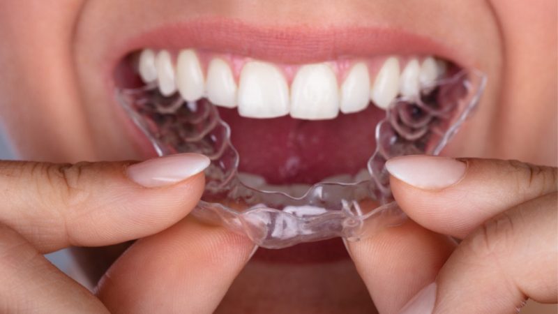 Orthodontie moderne : options pour redresser vos dents